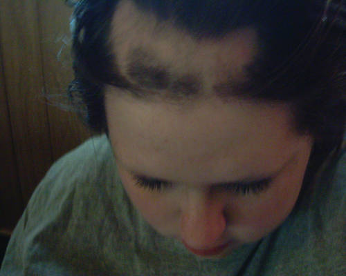 Trichotillomania