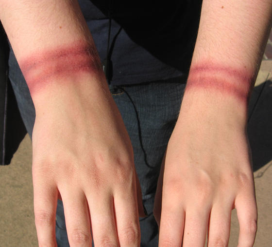 Light Rope Burn Rope Burns by FXHolic on DeviantArt