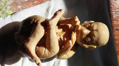 Werewolf fetus