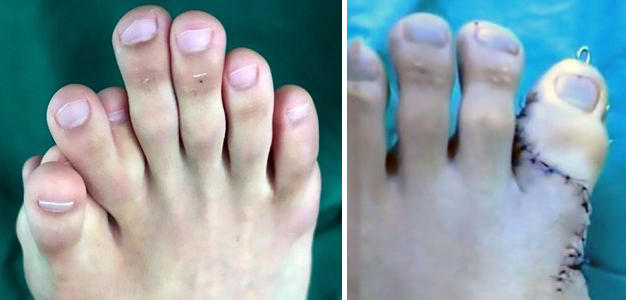 9 toes post operation by solitaryfranz on DeviantArt