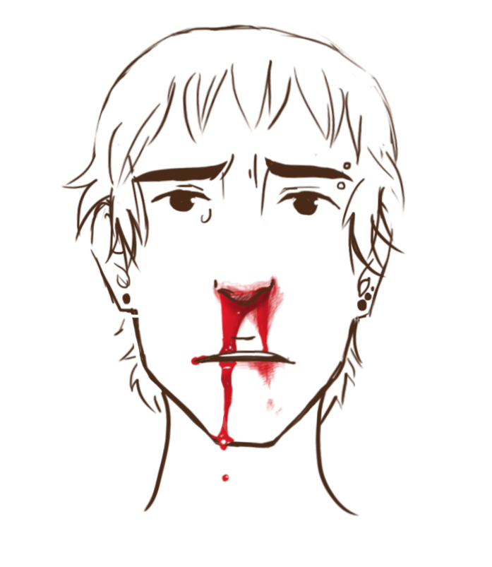 Epistaxis