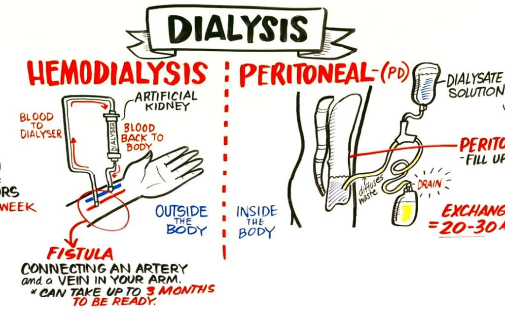 Dialysis Method Example Dialysistypes by healthdialysis on DeviantArt