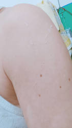 Shoulder with dark spots and armpit wrinkles