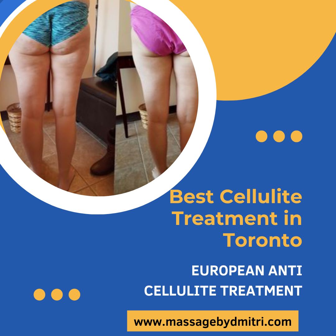 Best Cellulite Treatment in Toronto by massagebydmitri on DeviantArt