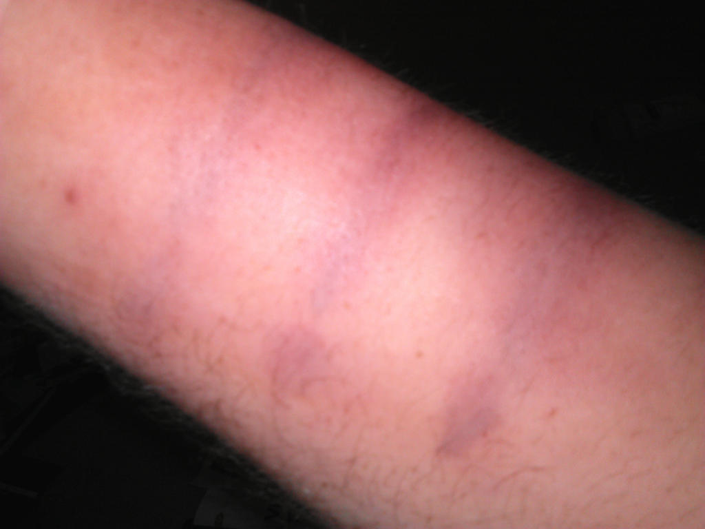 Hand Print Bruises by cbmtheatre23 on DeviantArt