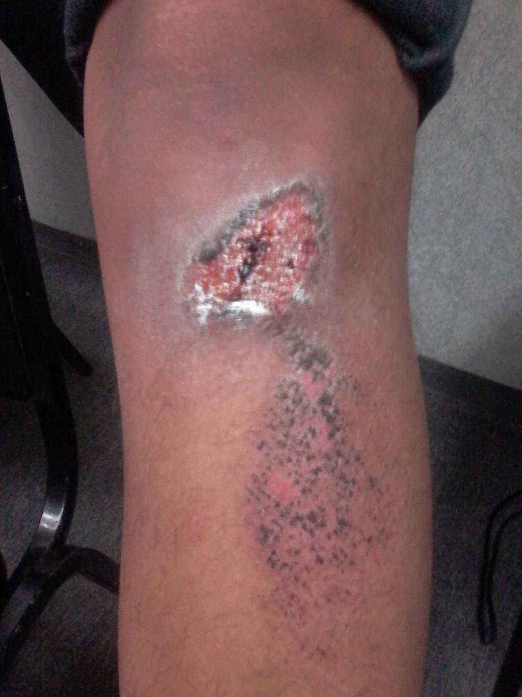 Scrape/Friction Burn - Real wound Reference. by Crimson-Werecat on  DeviantArt