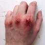 Scraped Knuckles