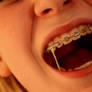 Braces