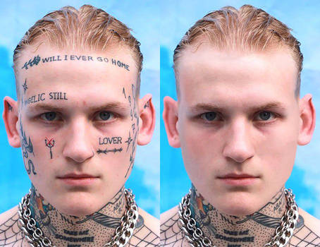 Face Tattoo Removal