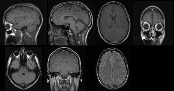 MRI Brain Scan - Medical