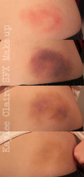 SFX #1: Bruises
