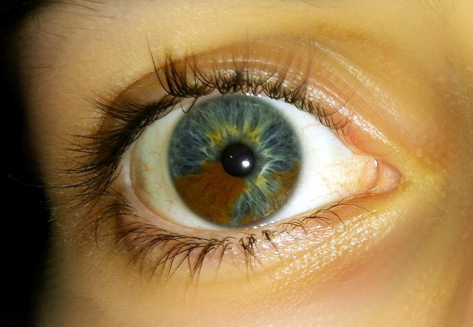 Пестрые глаза. Металлозная гетерохромия. Центральная гетерохромия карих глаз. Центральная гетерохромия зеленый Карий. Секторная гетерохромия глаза.