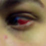 Bloody Eye