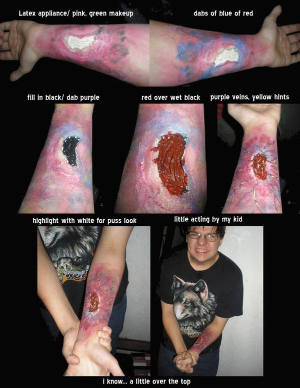 Infected Arm how to