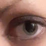 dilated eye