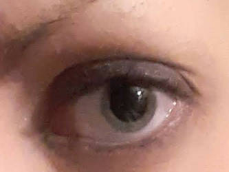 dilated eye