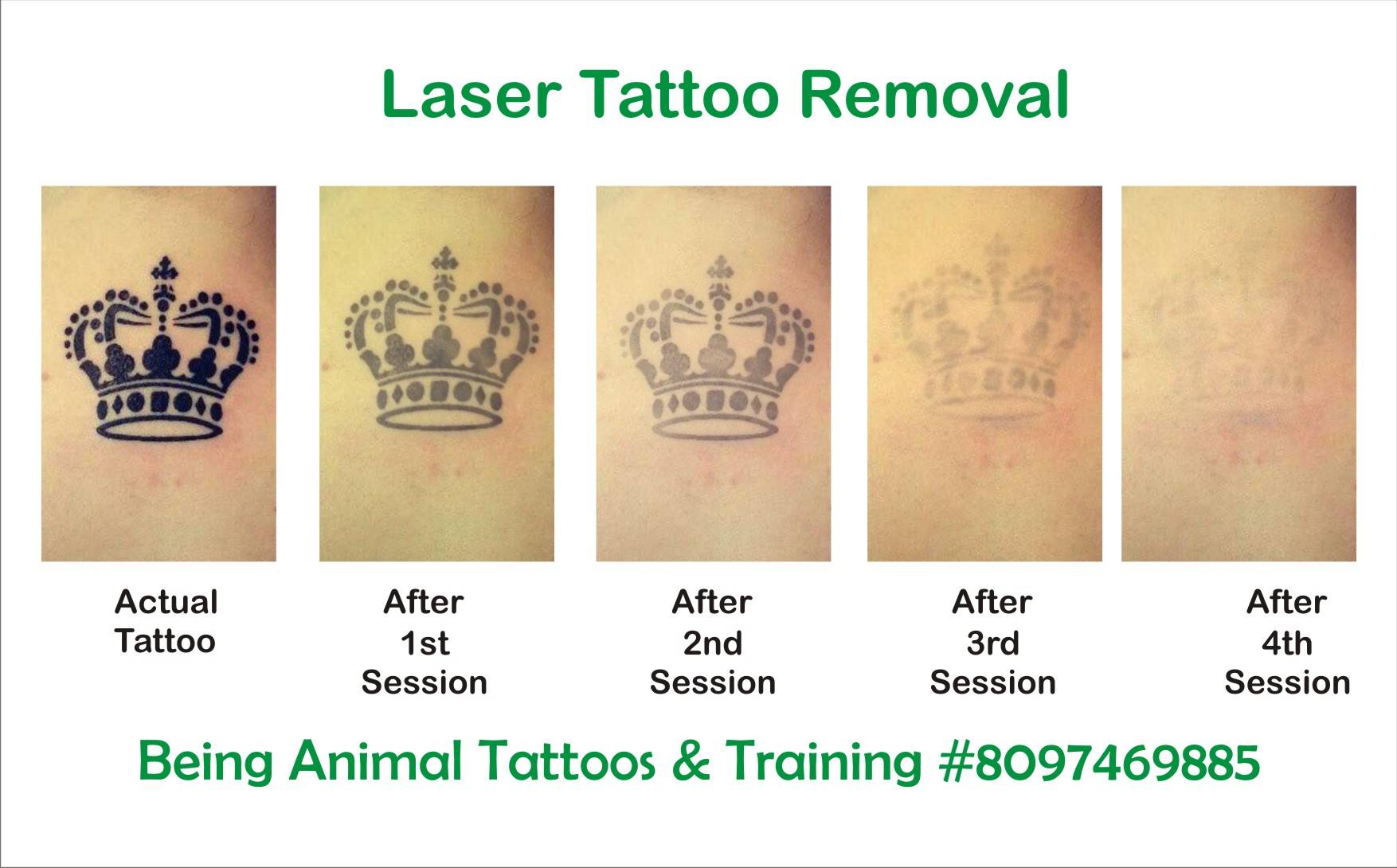 laser tattoo removal of crown by Samarveera2008 on DeviantArt