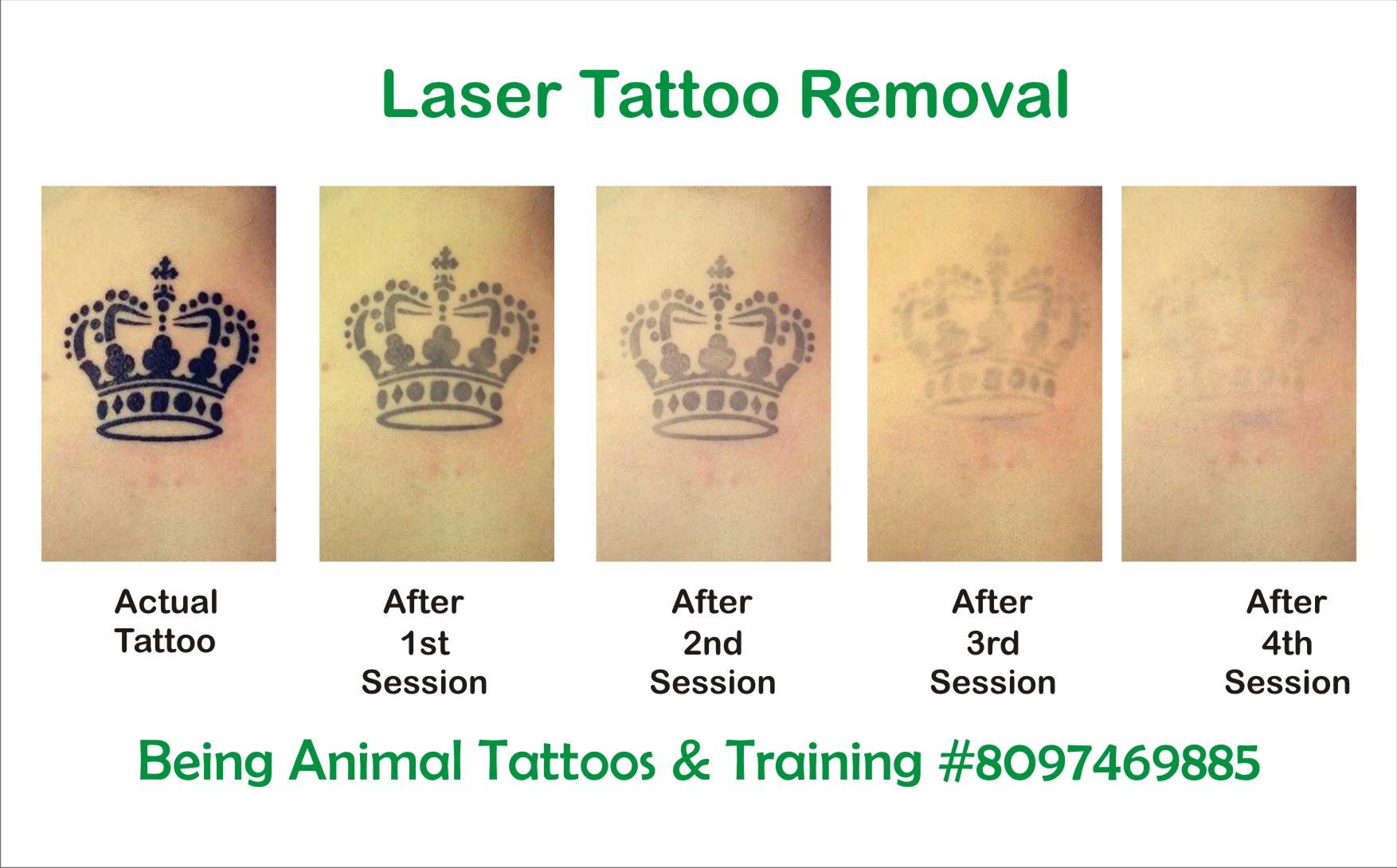 laser tattoo removal of crown by Samarveera2008 on DeviantArt laser tattoo removal of crown by Samarveera2008 on DeviantArt