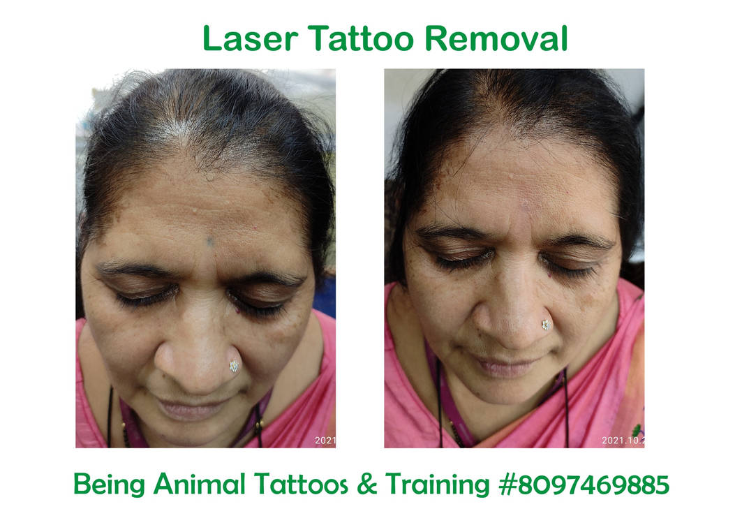 Laser tattoo removal love FOREHEAD being animal ta by Samarveera2008 on  DeviantArt