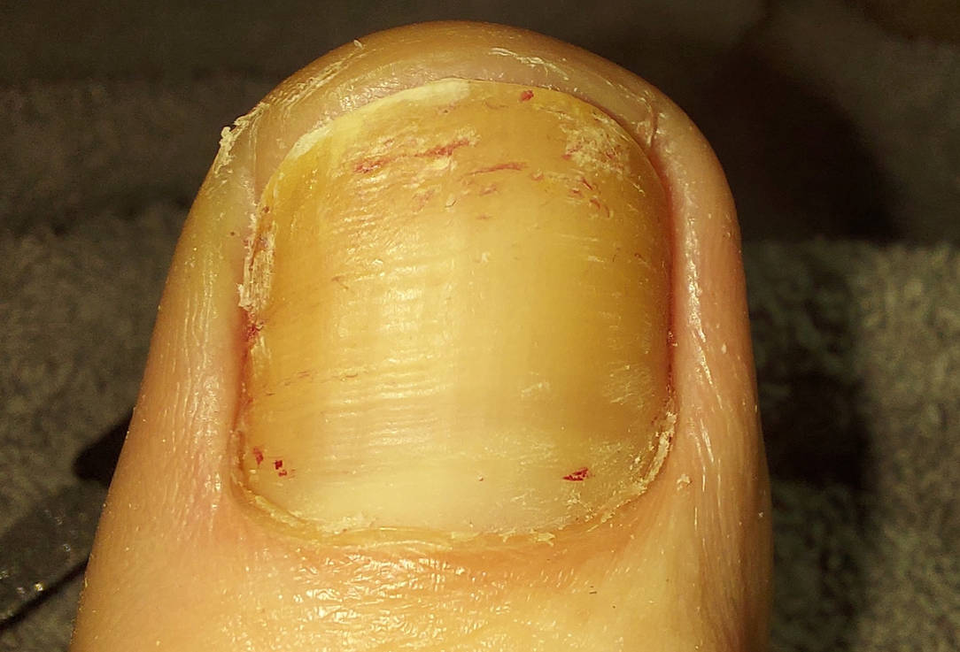 Toes Discusting Disgusting dry gross cracked cheesy big toe by JaneDoesFeetAndToes on ...
