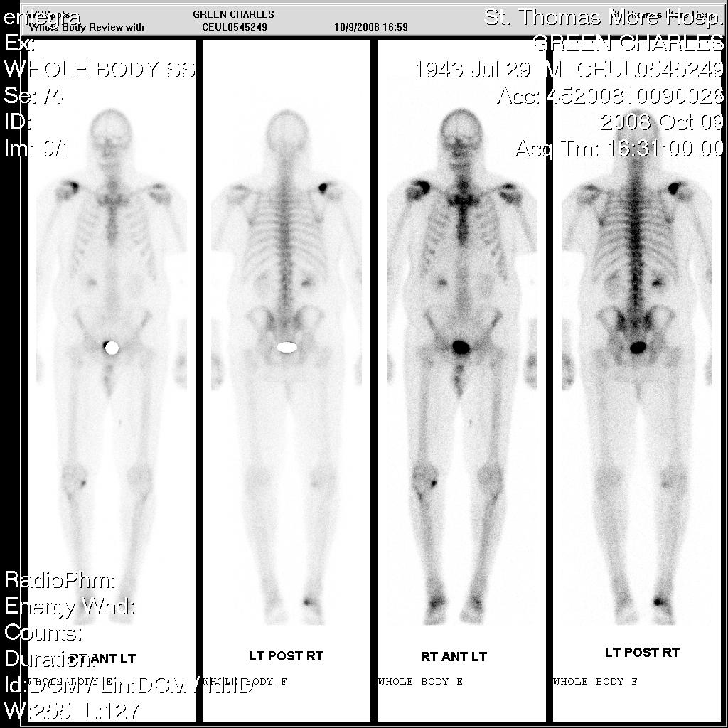 My Bone Scan test, full body by oldbogus on DeviantArt