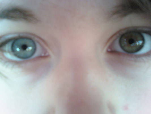 Heterochromia.