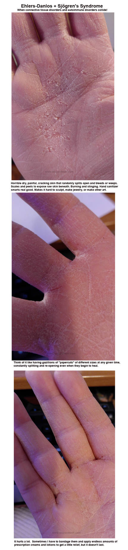 Ehlers Danlos + Sjogrens Info Graphic by leopardwolf