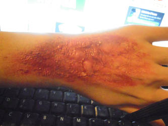 special fx play around - Burns. Hand/wrist