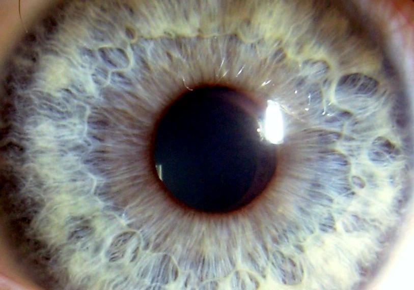 Eye