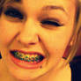 Braces