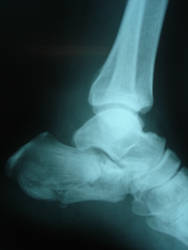 Ankle X-Ray 6785767 by StockProject1