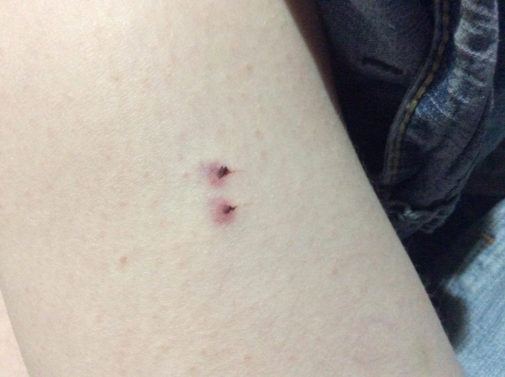 Cat Scratch puncture Wound By Moondancer150 On DeviantArt cat-scratch-puncture-wound-by-moondancer150-on-deviantart