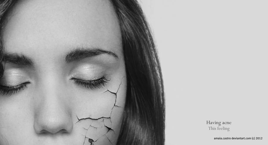 Acne by amaiacastro98