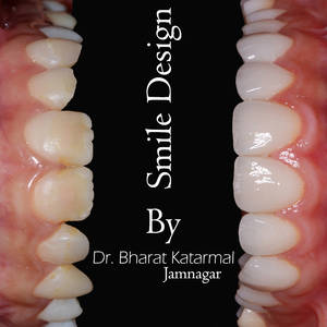 Dr. Bharat Katarmal - Ceramic veneers- Jamnagar