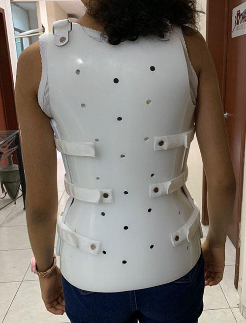 Double shell scoliosis brace_Back by barbaramw on DeviantArt