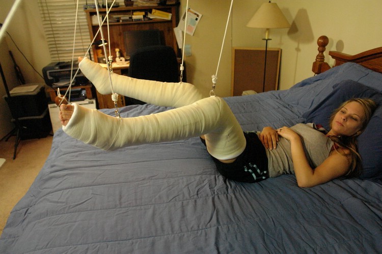 Term Leg Cast double leg casts in traction by voidReala on DeviantArt