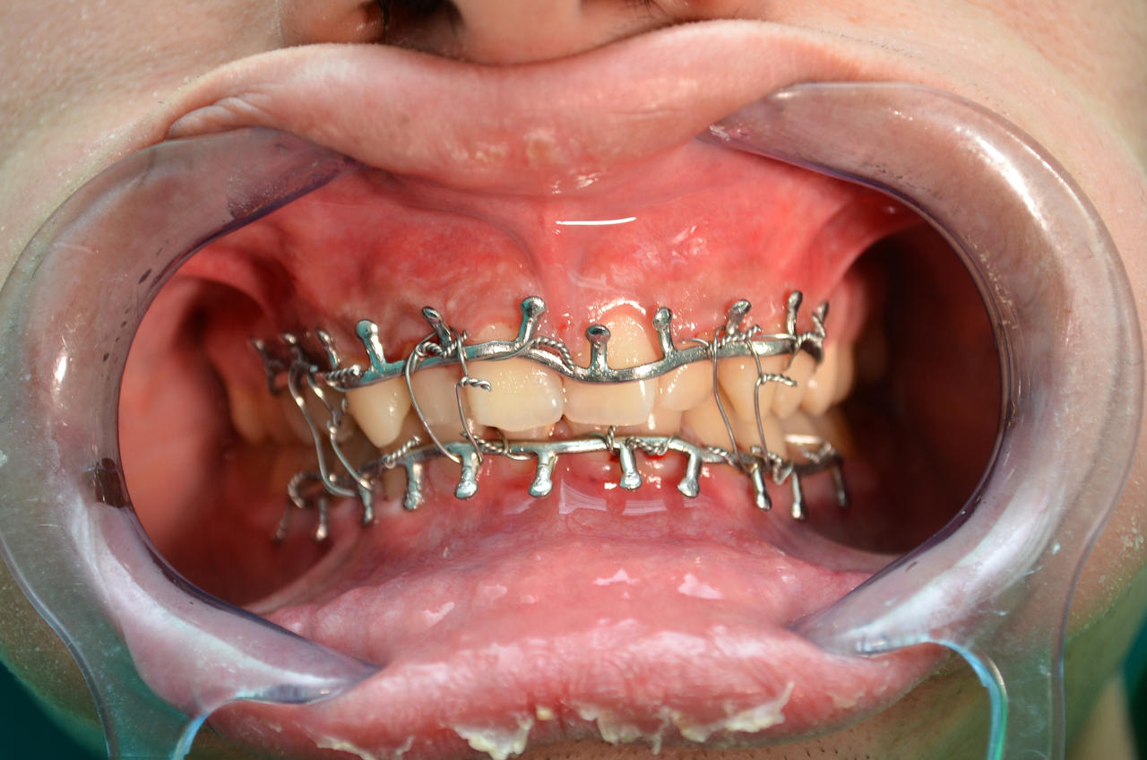Jaw wiring By Castedhalobrace On DeviantArt jaw-wiring-by-castedhalobrace-on-deviantart