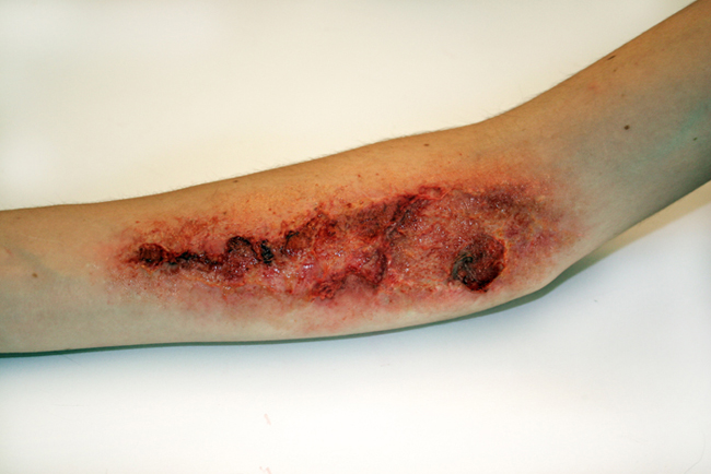 forearm wound