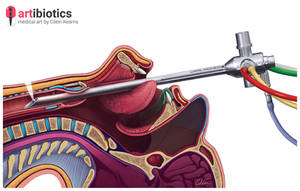 Bronchoscope