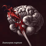 Brain aneurysm rupture by cilein