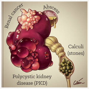 Haematuria causes #2