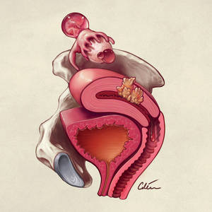 Gynae causes of haematuria