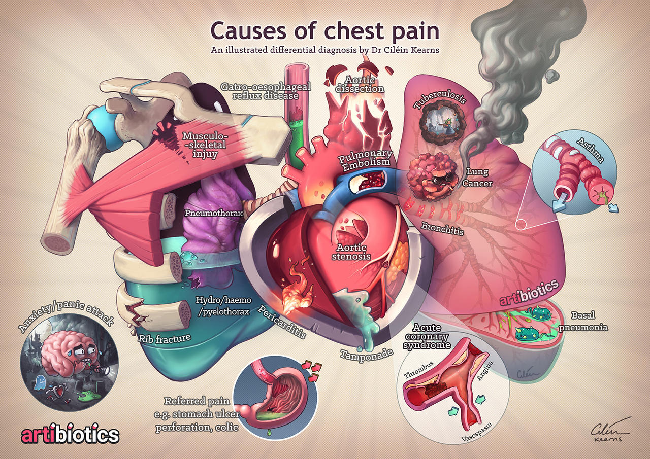 Causes of chest pain