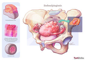 Endosalpingiosis