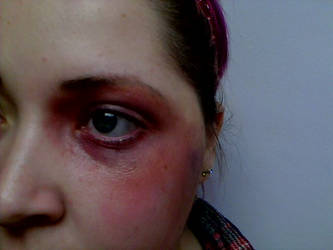 Black Eye