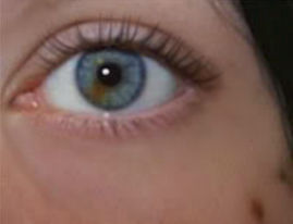 Sectoral Heterochromia