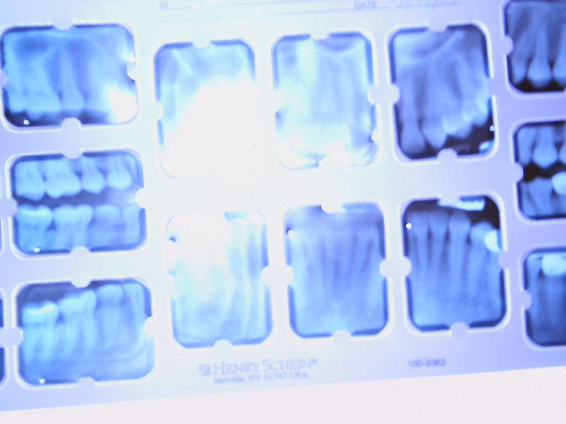 fmx- full mouth series x-ray by haruhara on DeviantArt