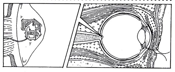 Microchipped optic nerve