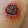 Infected Space Parasite Bite