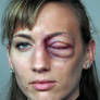 Swollen Eye Prosthetic Makeup